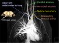 Arteria lusoria MRA MIP - Annotated
