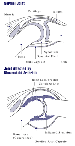 Rheumatoid arthritis joint