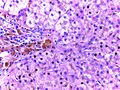 Hemochromatosis Liver