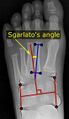 Sgarlato's angle of metatarsus adductus