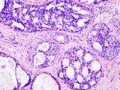 Breast DCIS histopathology