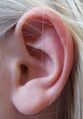 Otoplasty