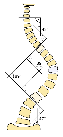 Cobb angle measurement in scoliosis