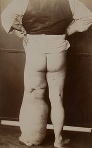 'Elephantiasis' of the leg
