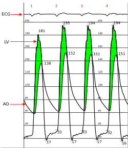 Aortic Stenosis - Hemodynamic Pressure Tracing