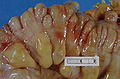 Diverticula in the sigmoid colon