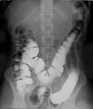 Human intestinal tract, as imaged via double-contrast barium enema