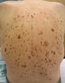 Seborrheic keratosis on human back