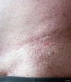 Fabry disease