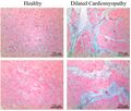Histopathology of interstitial fibrosis in dilated cardiomyopathy