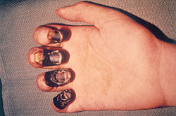 Acral gangrene due to plague