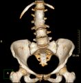 Congenital vertebral anomaly