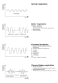 Diagram of various breathing abnormalities.