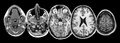 MRI Head 5 slices