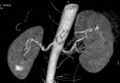 CT angiography showing fibromuscular dysplasia