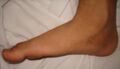 Flat feet (pes planus), common in Wilson–Turner syndrome