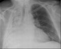 Mediastinal shift