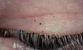 Pubic lice on eye-lashes