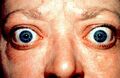 Proptosis and lid retraction from Graves' Disease