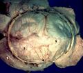 Middle meningeal artery