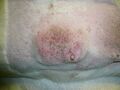 Mammary tumor
