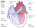 Atrial septal defect