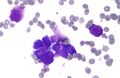 List of vaginal tumors