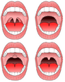 Uvulopalatopharyngoplasty