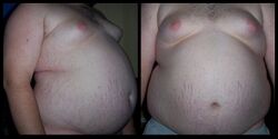 Obesity