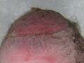 Bruised scalp after vacuum extraction