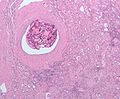 Embolization kidney