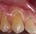Gum graft procedure