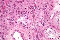 Leydig cell tumour