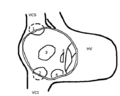 Schematic drawing of various types of atrial septal defect