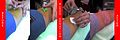 Blood donation needle