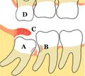 Lower mandibular third molar impaction pericoronitis diagram