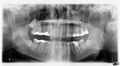 Panoramic radiograph of teeth