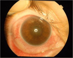 Non-granulomatous anterior-uveitis with nuclear cataract and ciliary injection