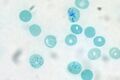 Reticulocytes Human Blood Supravital Stain