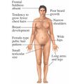 Polysomy