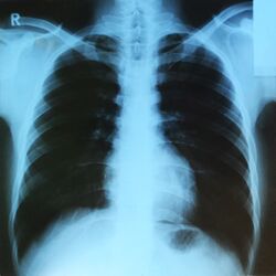 x-ray