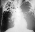 Chest X-ray showing tuberculosis