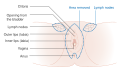 Diagram of a 3 in 1 incision vulvectomy