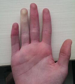 Raynaud's Phenomenon