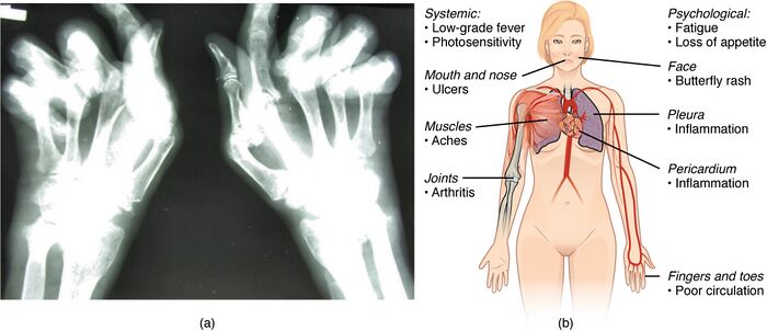 Auoimmune disorders