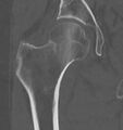 CT of subtle compressive hip fracture