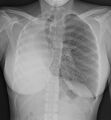 Pulmonary hypoplasia