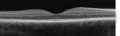 Spectral domain OCT cross-section of the macula