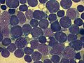 Acute lymphoblastic leukemia