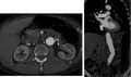 Abdominal CT angiography